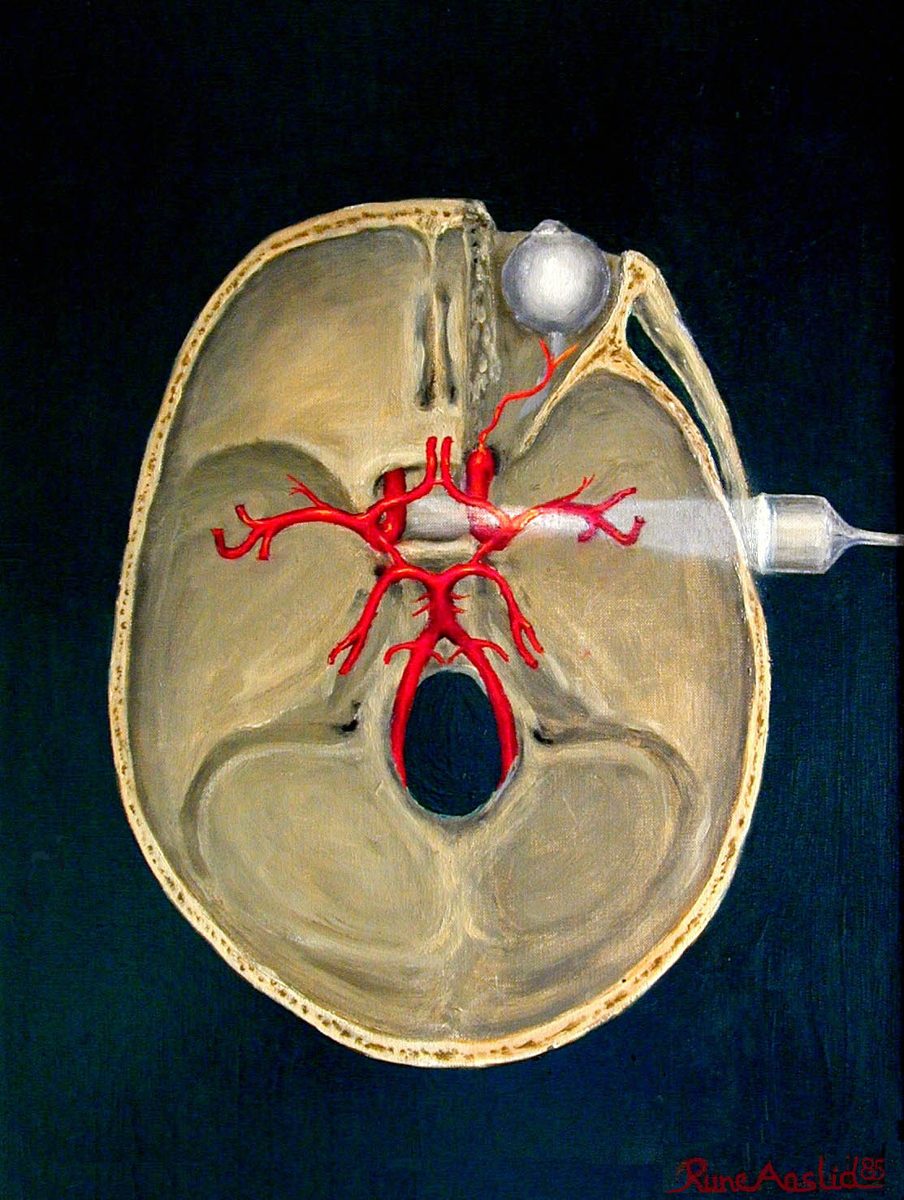 Ilustración de la sonda de Doppler en la sien apuntando a las arterias del cerebro