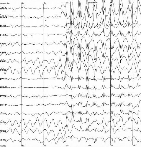 Trazo de electroencefalograma con descargas de punta onda