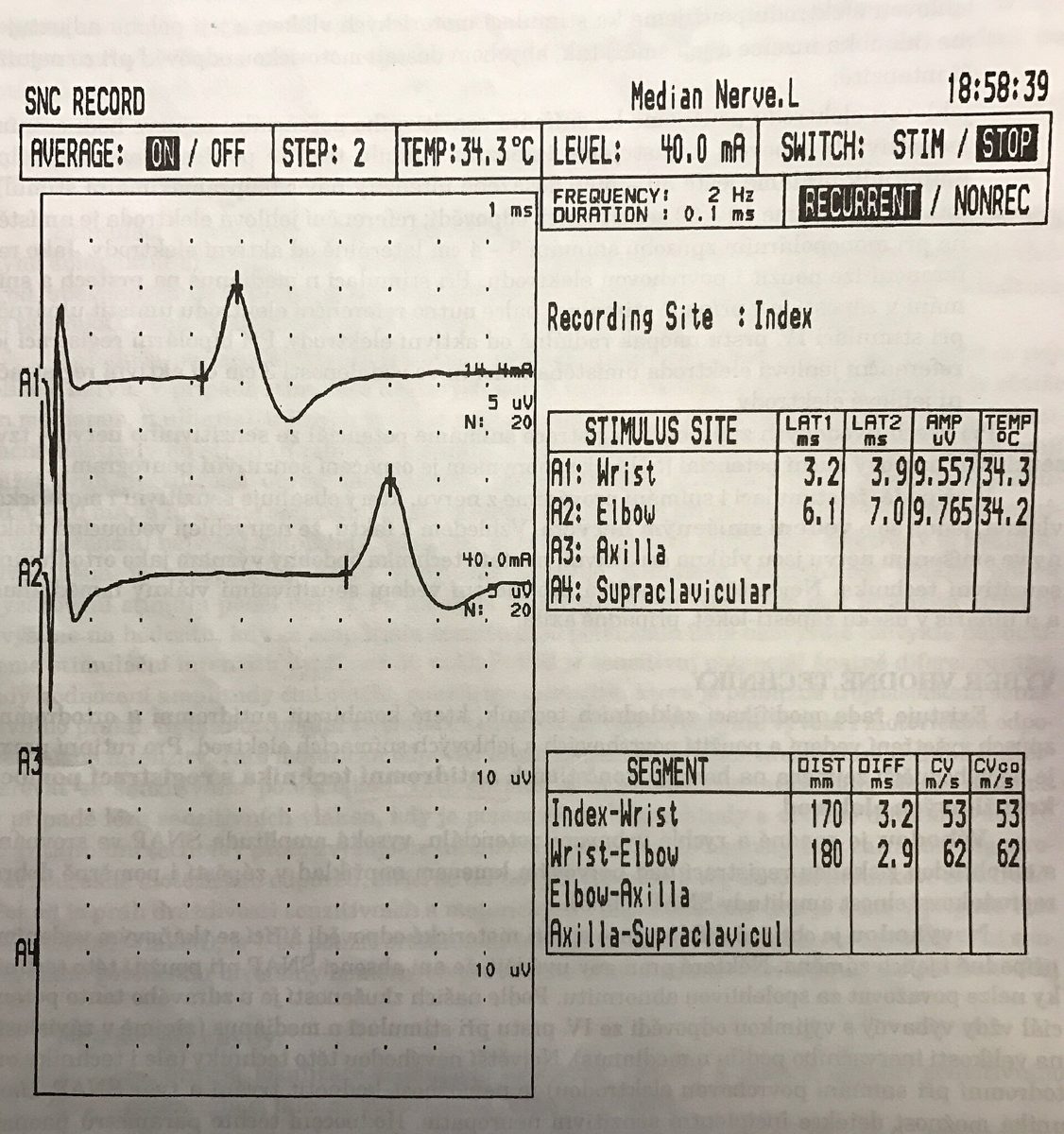 Reporte impreso de neuroconducción del nervio mediano
